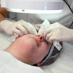 Teen Acne Extraction Facial Treatment in Fullerton Teen boy receiving professional acne extractions under a magnifying lamp during a corrective facial treatment.