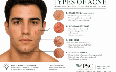 Acne Types