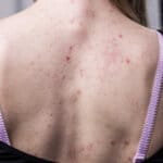 Customized back acne treatment at Personalized Skin Care in Fullerton