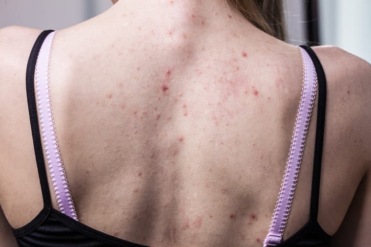 Customized back acne treatment at Personalized Skin Care in Fullerton