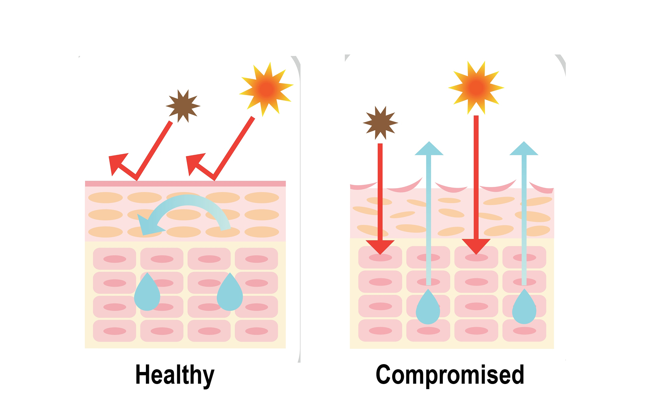 Clinical infographic comparing dry skin and compromised skin using simplified skin‑layer diagrams with TEWL arrows, lipid matrix disruption, and redness indicating inflammation.