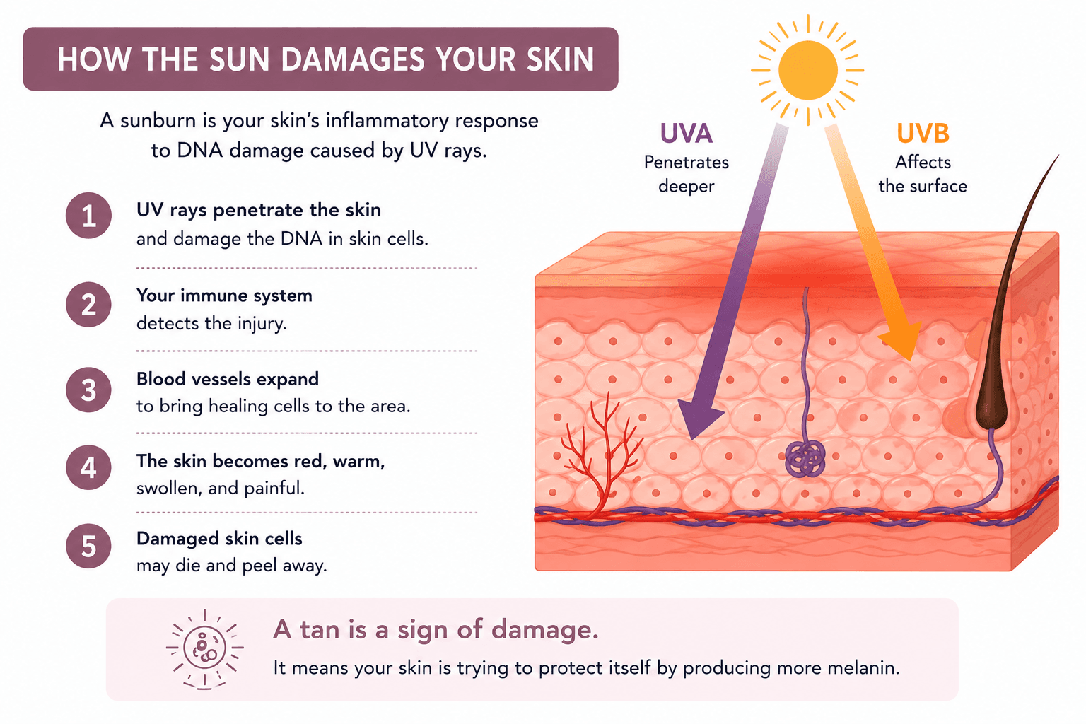 Educational infographic showing how UVA and UVB rays damage the skin, how sunburn develops, and why a tan is a sign of skin damage.
