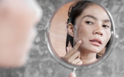 Summer Hyperpigmentation: Why Dark Spots Get Worse