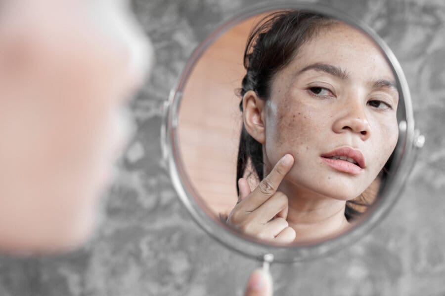 Summer Hyperpigmentation – Why Dark Spots Get Worse Woman with facial hyperpigmentation and dark spots illustrating how summer sun and heat can make uneven pigmentation more noticeable.